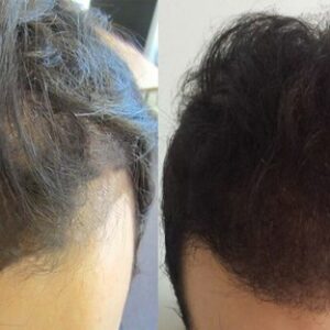 Advanced Hair Growth Serum with Redensyl 5%, Capixyl 3%, & DHT Blockers